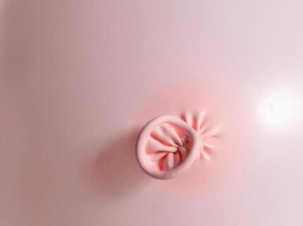 Extreme Gasbildung im Darm